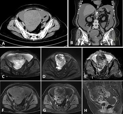 Carcinosarcoma of the ovary: a case report and literature review